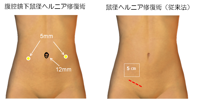 腹部創の比較